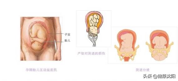 健康科普产后修复,盆底科普健康宣教小视频