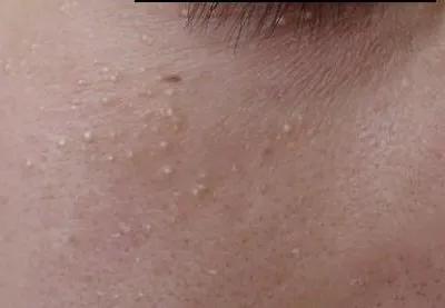 你长得真的是脂肪粒吗？如何解决“脂肪粒”？