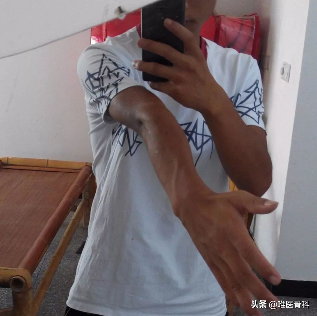 胳膊肘错位肘内翻,先天肘内翻有办法改善吗