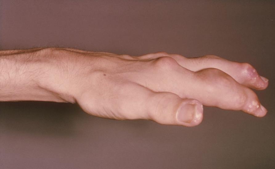 尿酸高怎么才能进一步确认是痛风,尿酸高痛风怎么办医生告诉你方法