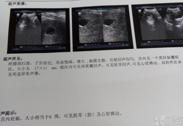 宫内妊娠48天选择什么流产术,终止妊娠是药流还是人流