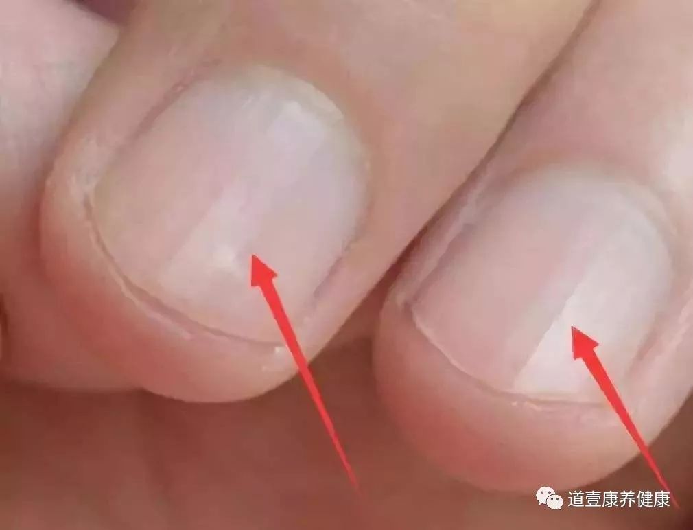 指甲根部凹陷不平整,指甲凹陷不平是什么原因