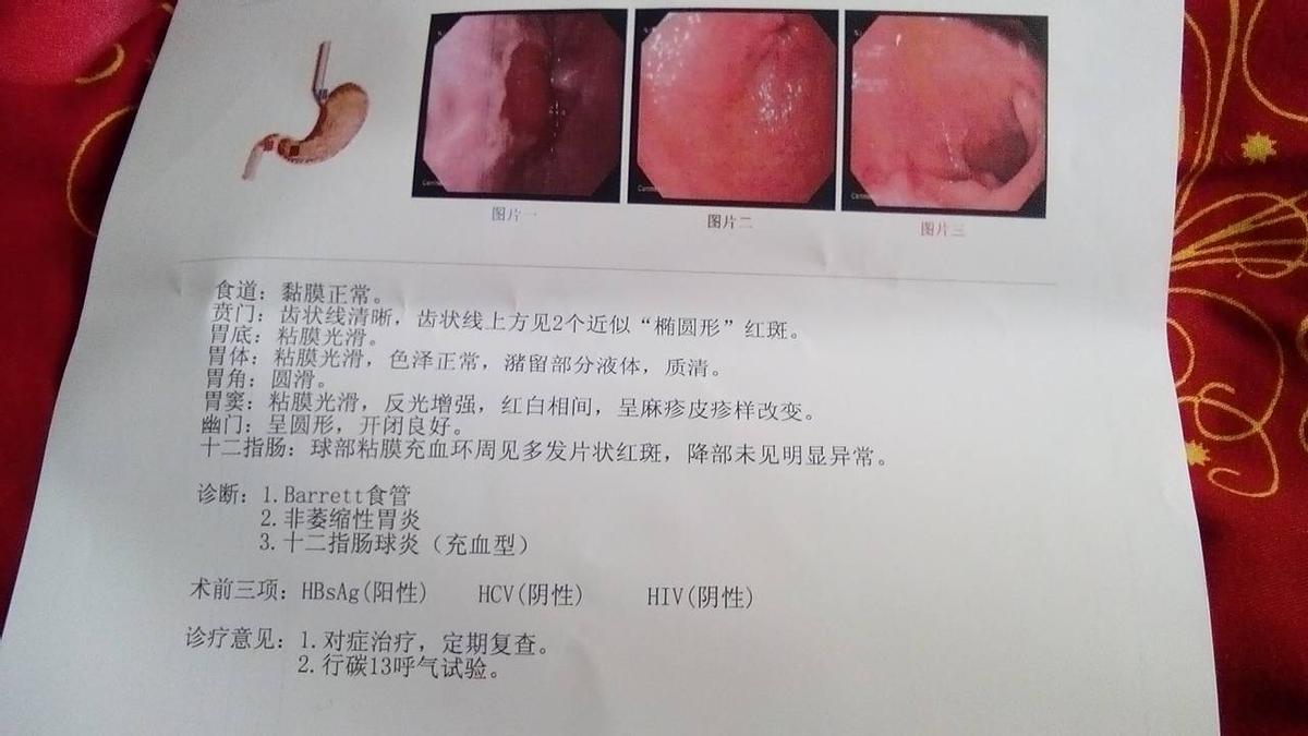 做胃镜是无痛还是做普通的好,做胃镜是做无痛的好还是普通的好