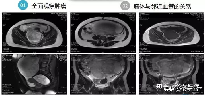 卵巢肿瘤核磁共振能看出来吗,超声测出来肿瘤