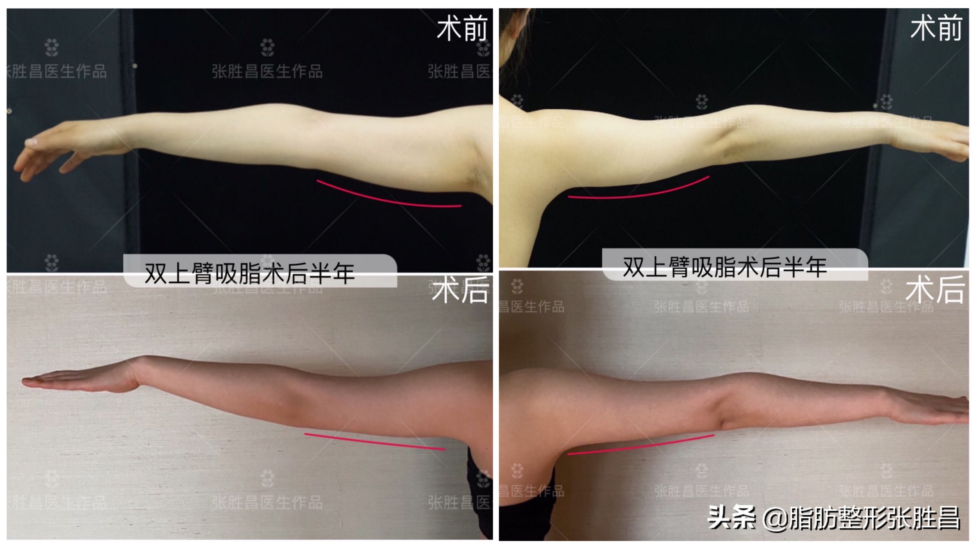 既能瘦手臂又能练出手臂肌肉,瘦手臂最简单健身动作瘦身