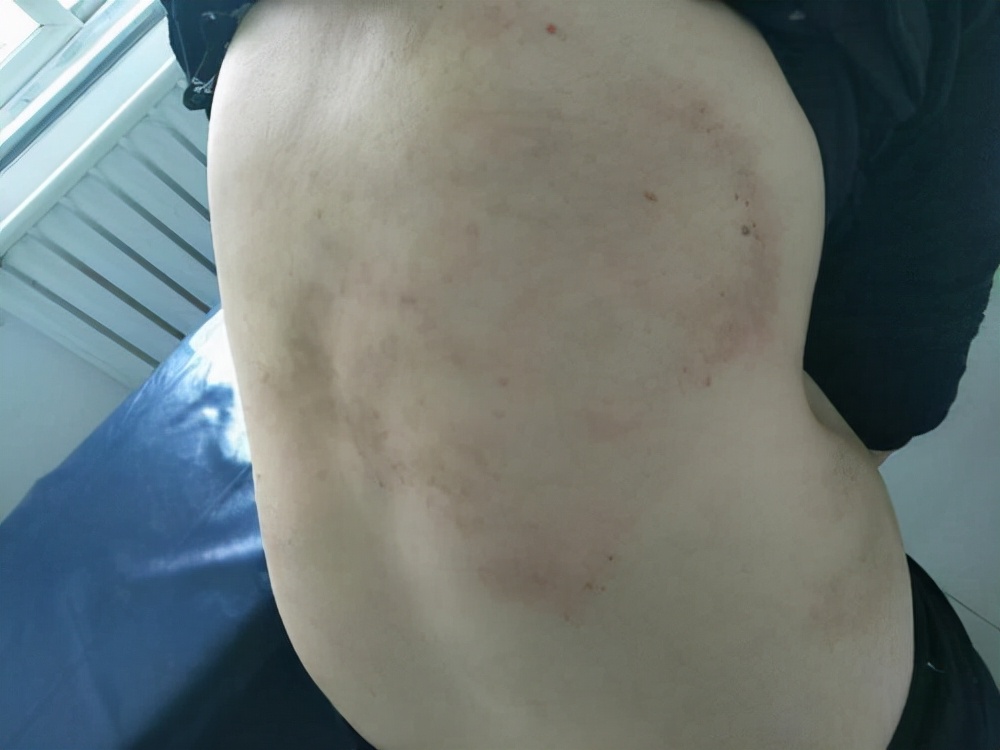 冬天小腿干燥发痒跟血糖有关系吗,血糖不高全身发痒是什么原因