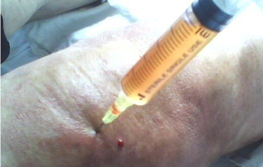 滑膜炎导致的膝盖积液用不用抽取,关节炎有积液属于滑膜炎类型吗