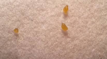 嘴巴抿起来有白色小颗粒怎么去除,抿嘴下巴颗粒怎么去除