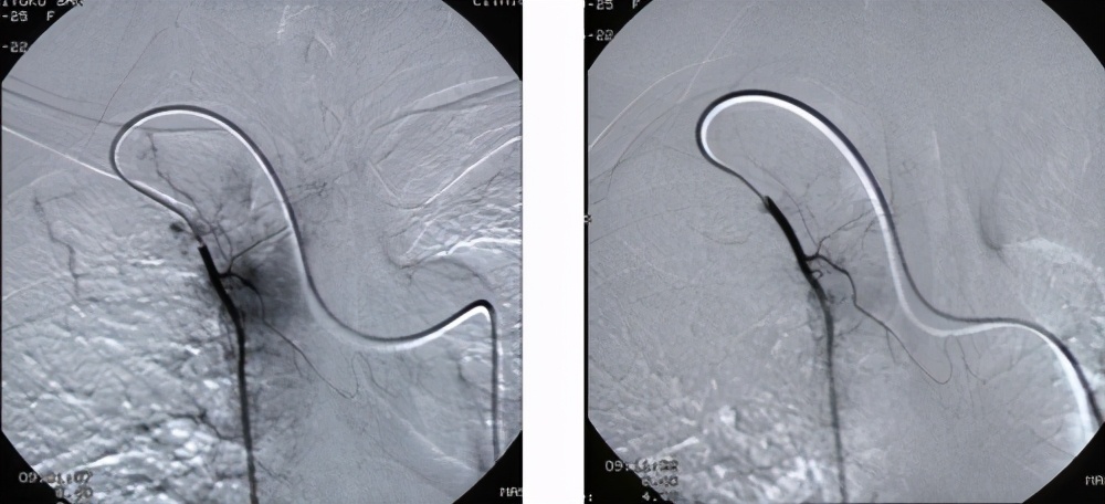 微创介入治疗肿瘤,介入治疗对肿瘤有效吗