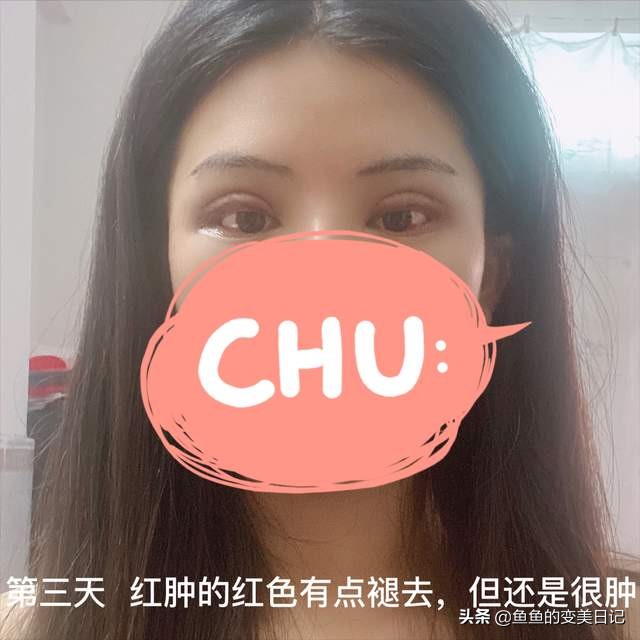 双眼皮知识点总结大全,关于双眼皮的十大真相