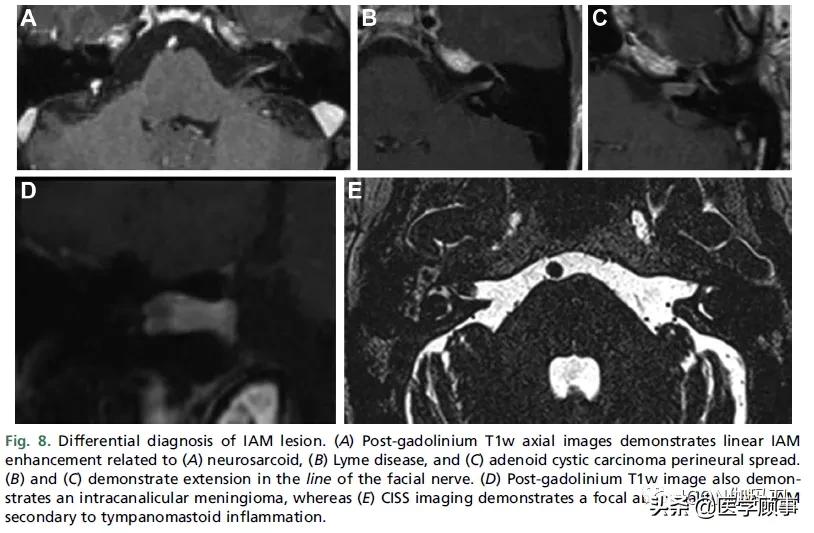 「综述」前庭神经鞘瘤的成像：诊断、监测、和治疗计划