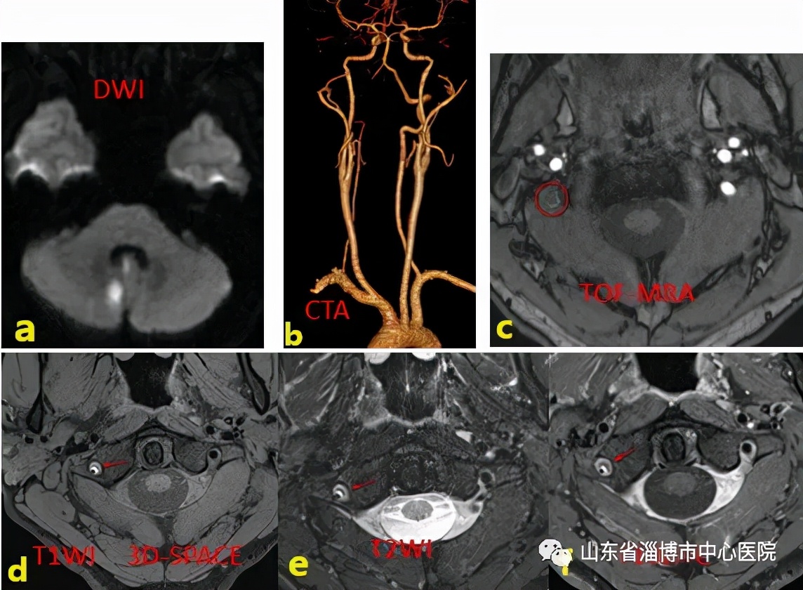 超声颈部血管斑块评估,颈动脉斑块mr成像技术