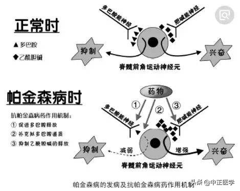 脑梗是不是能引起帕金森病呢,脑梗塞会引起脑出血吗怎么治