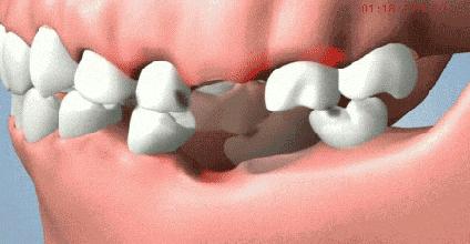 厦门一男孩摔掉门牙,孩子牙齿摔掉一半怎么办