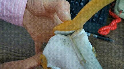 膝盖髌骨上下楼梯疼痛怎么办,髌骨外倾可以矫正过来吗