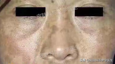 褐青色痣斑吃什么中药好,如何治疗脸上褐青色痣样斑