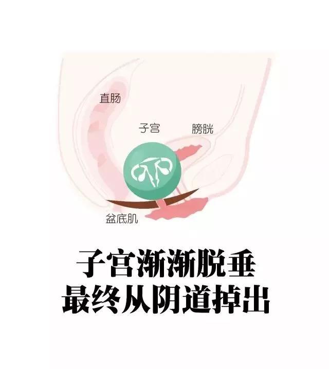 产后康复的时机、手法以及误区，一文读懂！