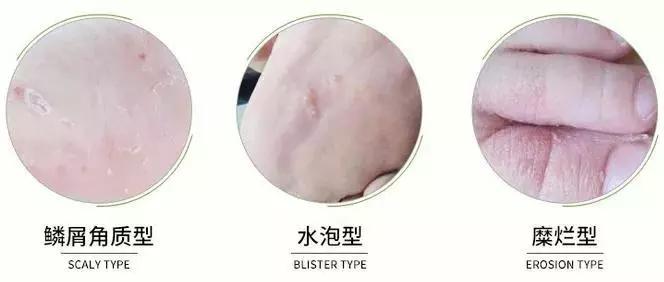 生理性脚臭喷雾,脚臭被人闻到很尴尬怎么办