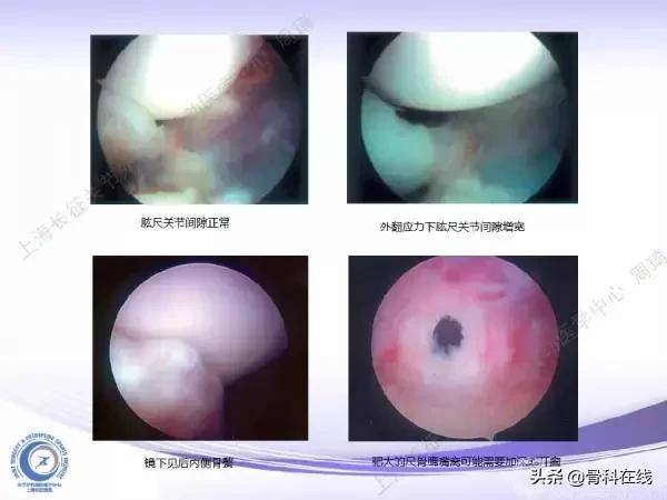 肘关节镜手术后引流,肘关节镜微创手术