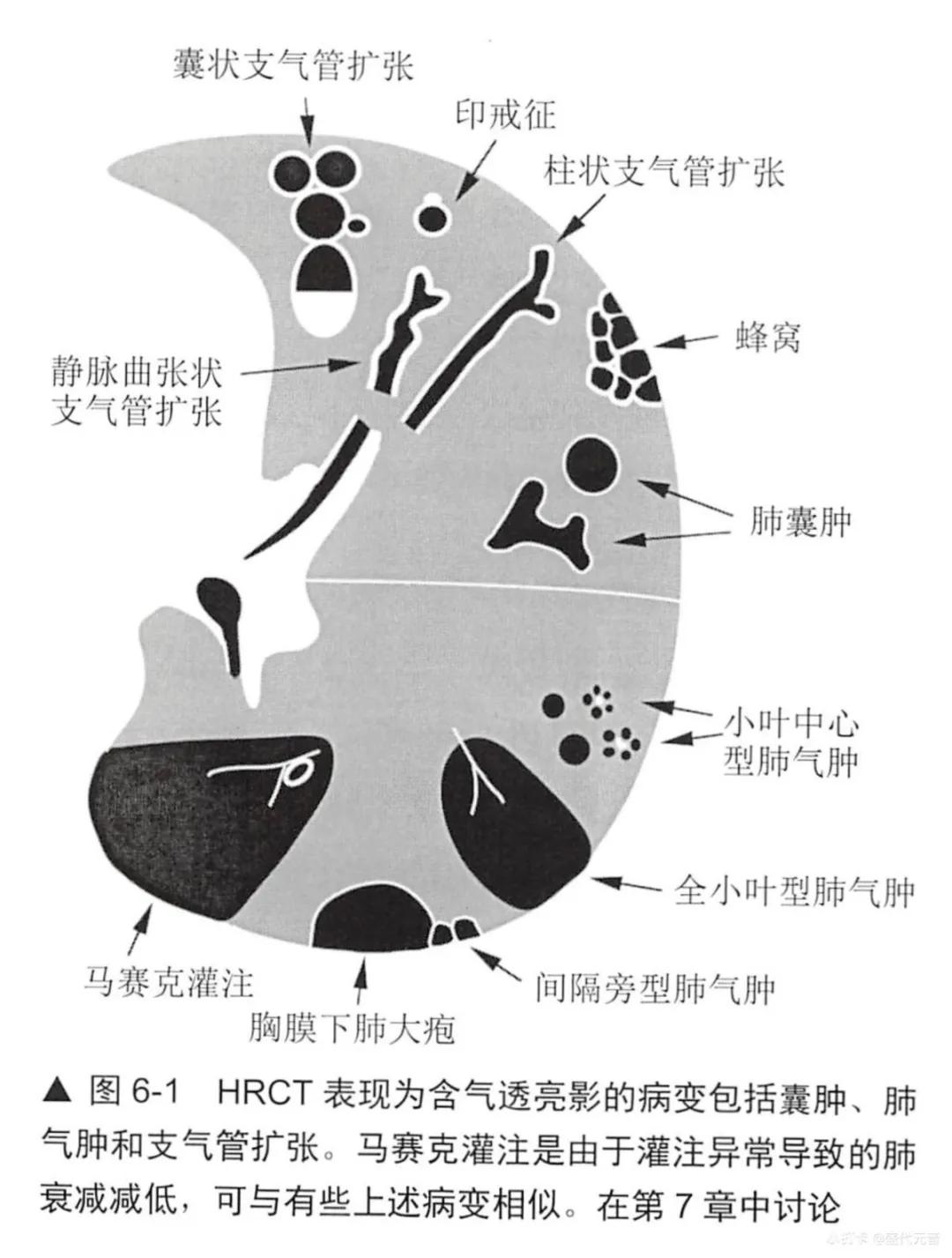 肺囊肿ct图像,肺hrct是低剂量的吗