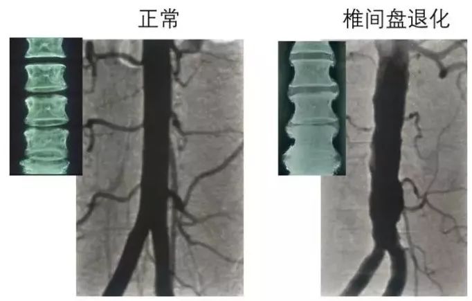 腰椎间盘突出坐骨神经痛如何缓解,腰椎间盘突出脚痛神经痛怎么缓解