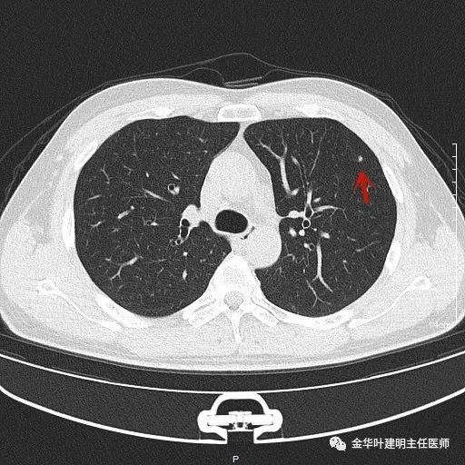 叶建明谈胸膜下的实性结节,叶建明肺实性良性结节会变癌症吗