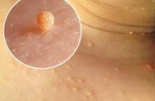 身上突然长了很多小肉疙瘩图片,身上突然长起小肉点会自己消除吗