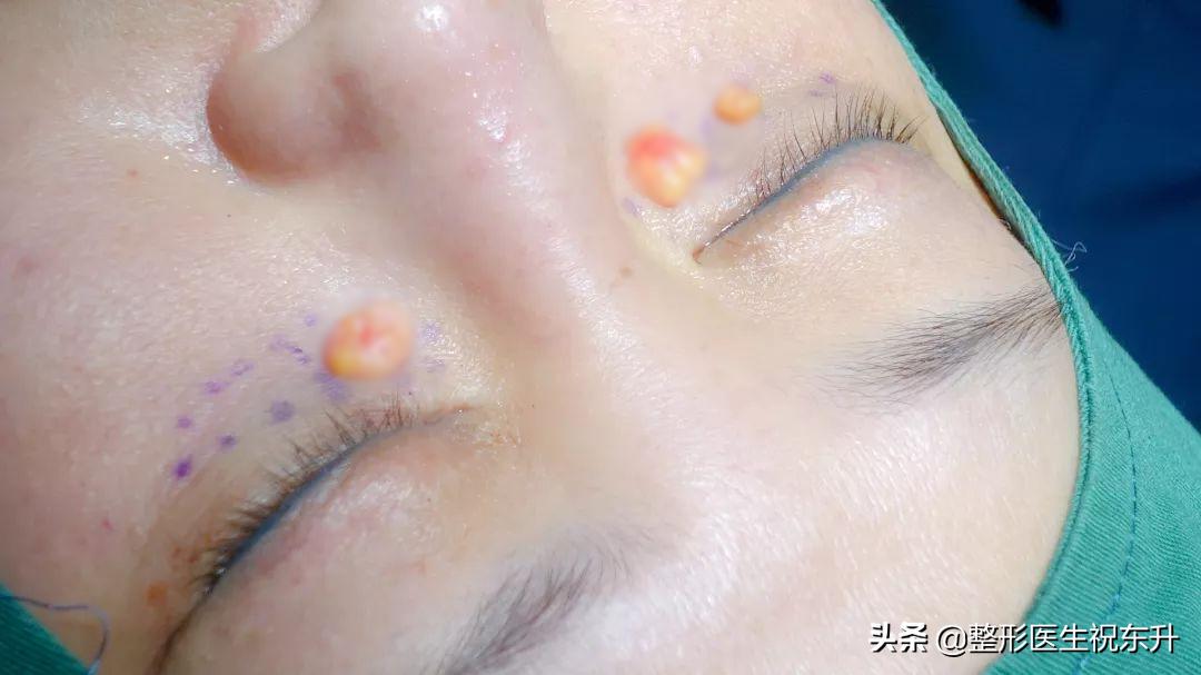 祛眼袋内切手术推荐一下,祛眼袋手术后悔的真实经历