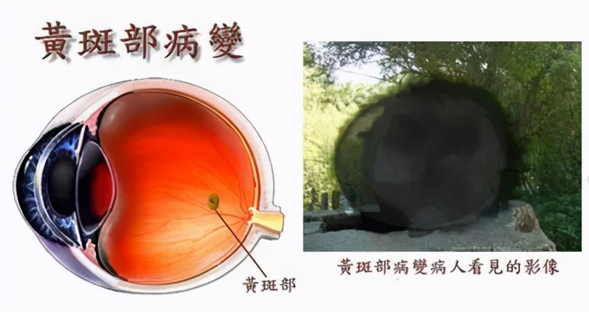 糖尿病眼底黄斑水肿打什么针好,糖尿病视网膜病变引起的黄斑水肿