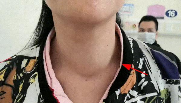 哈尔滨微创消融甲状腺结节哪家好,甲状腺结节微创消融术的过程