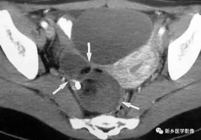 腹部平片能看到结石吗,腹部高密度结节影是什么