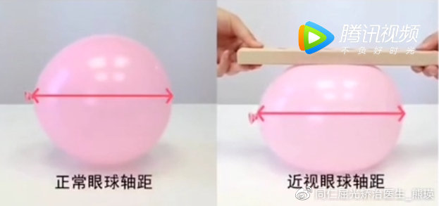 真性近视裸眼视力好转是好事吗,近视手术是怎样让眼睛恢复视力的