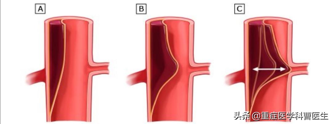 降压药不能擅自停服,降压药吃了不能吃啥
