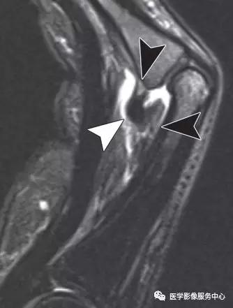 手腕撕脱性骨折一年了还隐隐作痛,手腕三角骨撕脱骨折症状有哪些