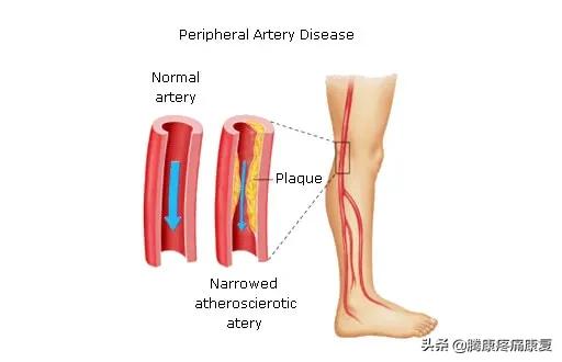 老人小腿疼痛是什么原因,脚小腿肌肉疼痛是什么原因