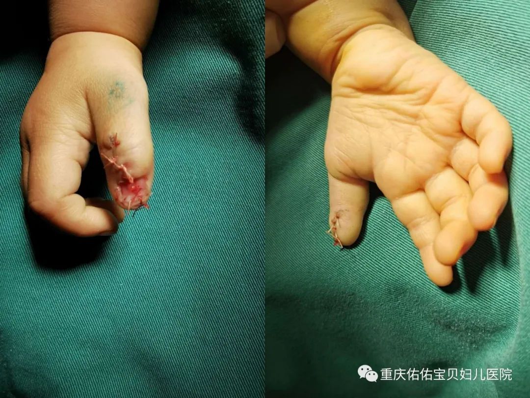 孩子出现多指畸形该怎么办,宝宝脚趾畸形多指最佳治疗时间