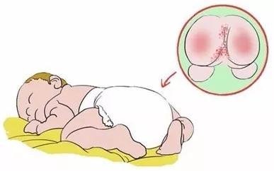 宝宝为什么一直红屁屁长疹子,为什么宝宝都会红屁股