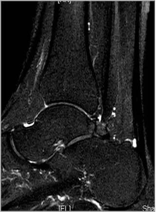 踝关节撞击症问诊,踝关节撞击综合征的x线表现