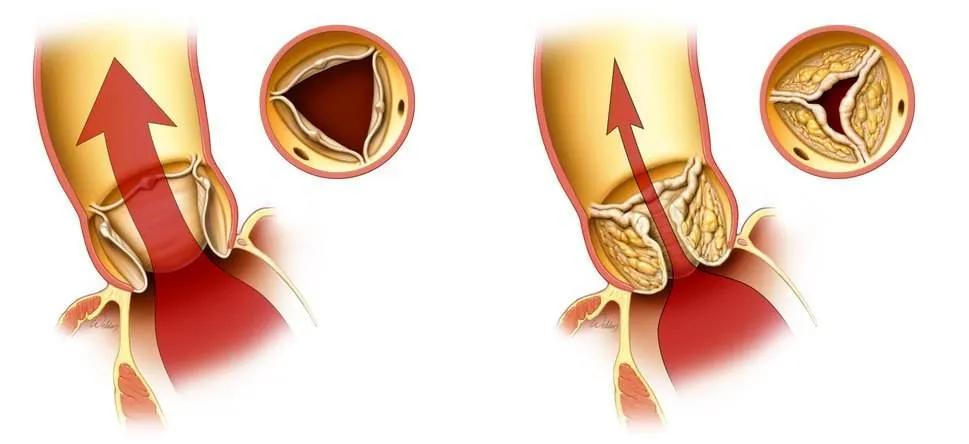 92岁老人心肺衰竭还能活多久,92岁爷爷肺不好