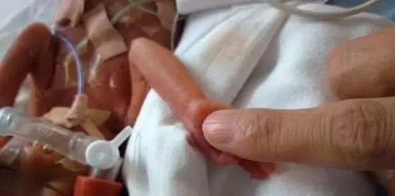 在深莞交界的光明，这位“伯伯”让早产宝宝的救治成功...