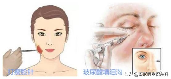 打瘦脸针和打玻尿酸哪个更安全,打了瘦脸针跟玻尿酸要注意啥