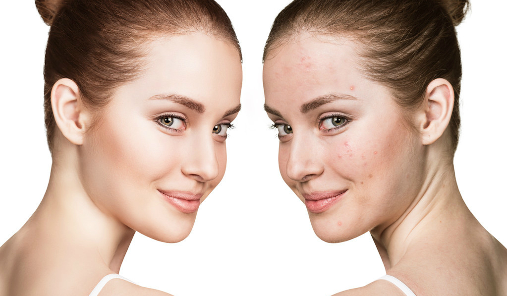 脸部长痘对应五脏六腑,长痘位置对应五脏六腑