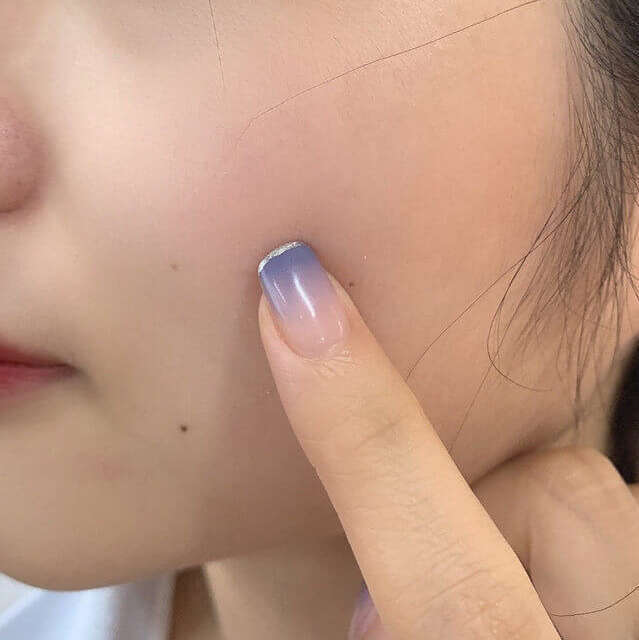 面部毛孔粗大如何改善,面部毛孔粗大如何改善效果最明显