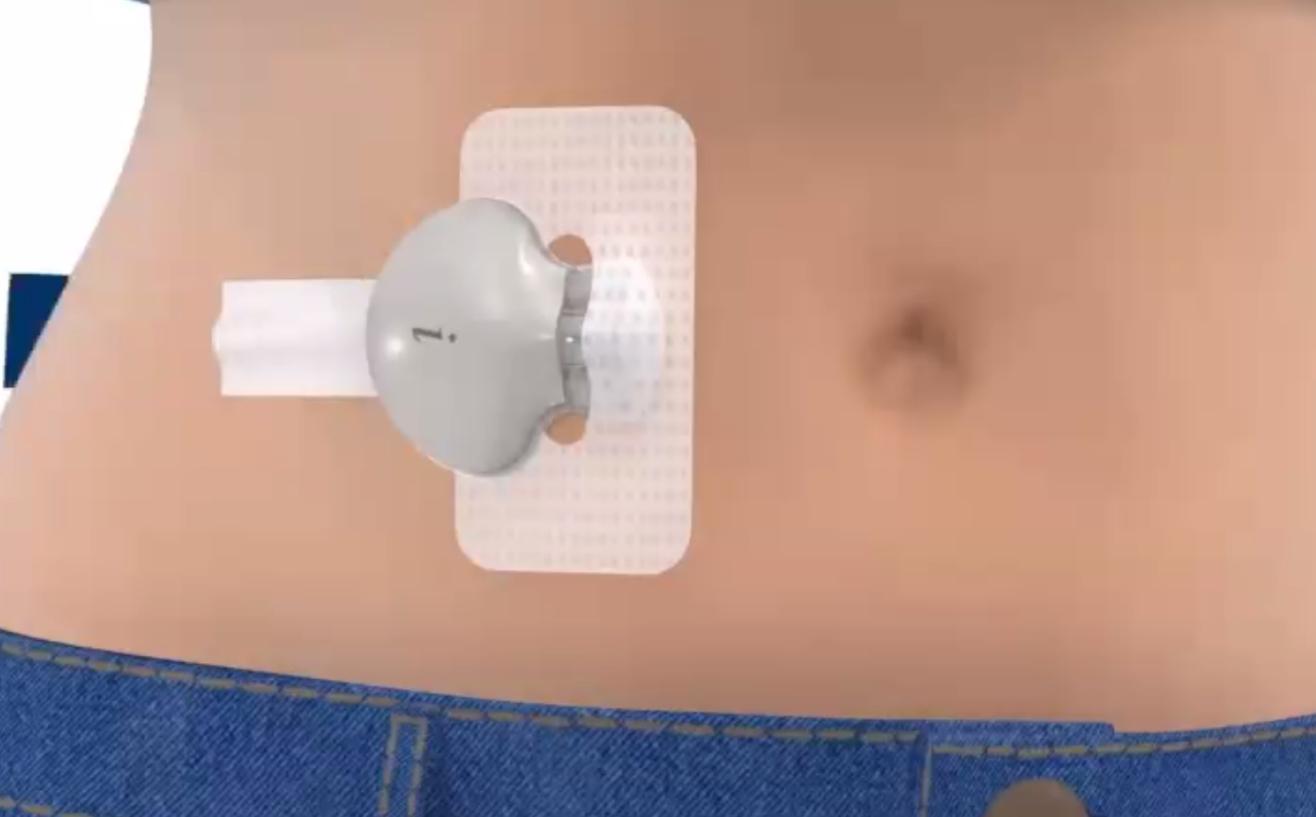 小贝壳动态测血糖降糖更精准,血糖监测小贝壳