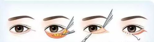 有眼袋怎么办按摩去眼袋,去眼袋眼霜真能去眼袋吗