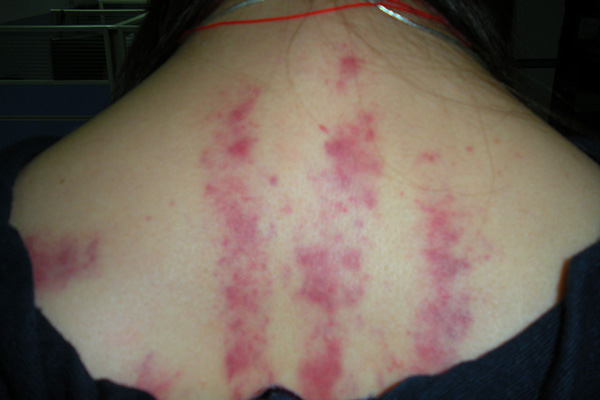 刮痧刮出痧是什么意思,刮痧刮出痧为什么会有好处