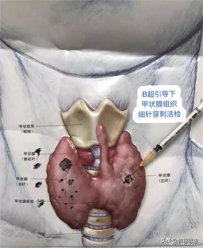 甲状腺穿刺报告可疑甲状腺癌,甲状腺穿刺报告写疑似恶性肿瘤