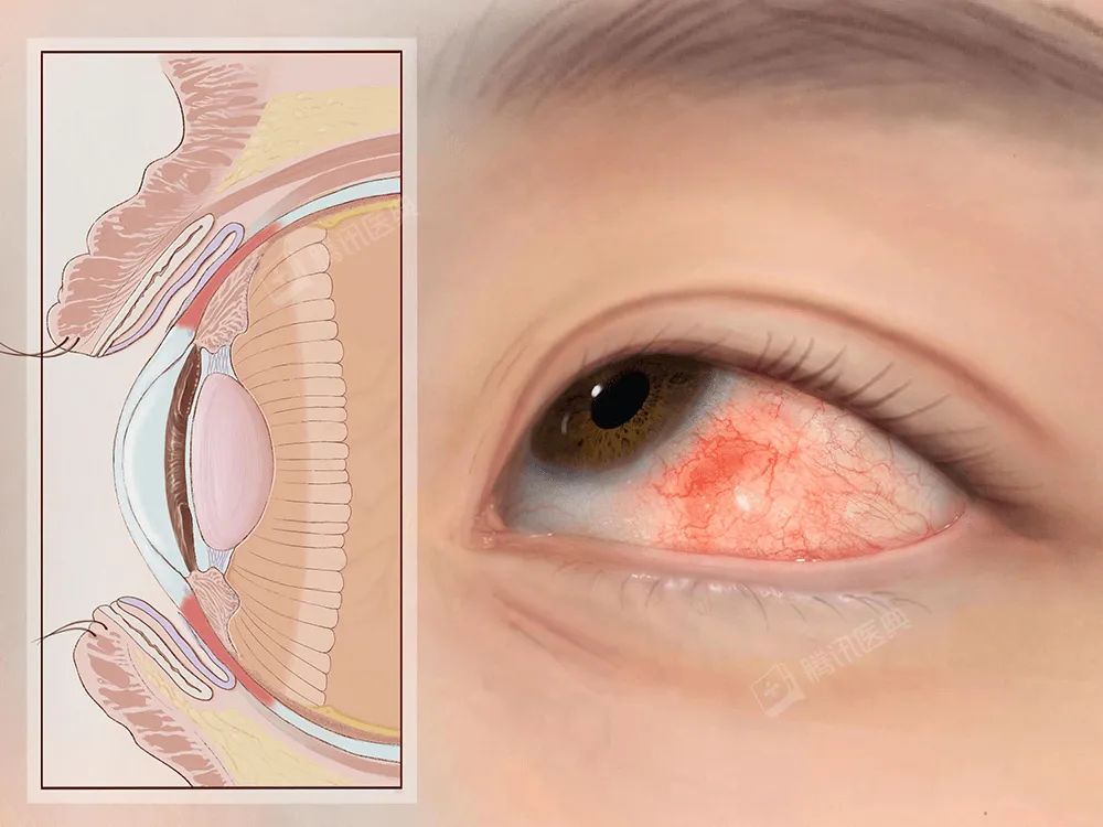 熬夜眼睛变红后，很多人都爱做这1件事，但其实更伤眼！