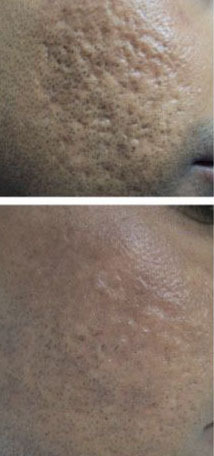 脸上痘印痘坑怎么消除最有效,痘坑怎么才能彻底解决