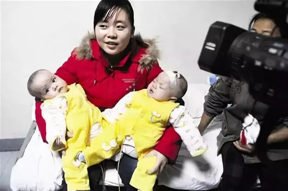 双胞胎坐骨连体成功案例,坐骨连体姐妹分离成功了吗